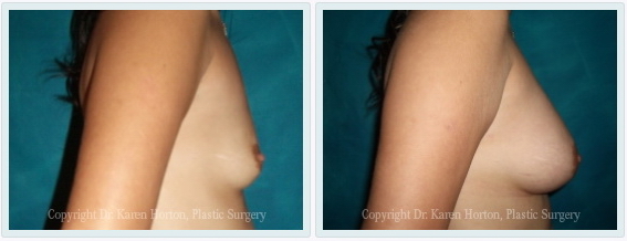 Breast Enhancement