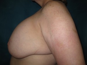 snoopy deformity submuscular implant breast ptosis