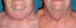liposuction-before-and-after