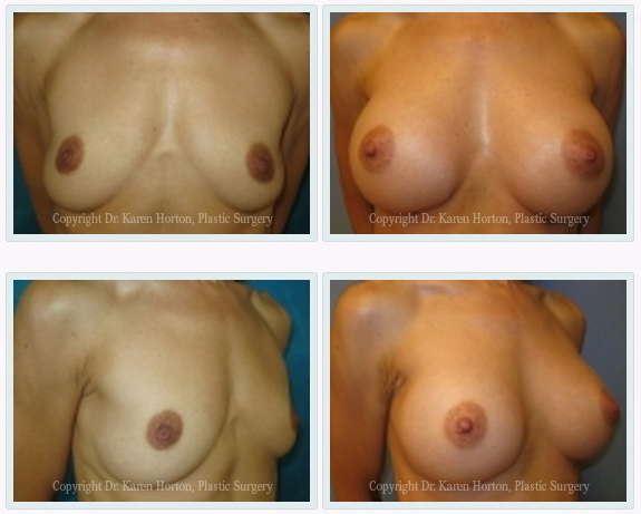 Before and after silicone gel breast augmentation in a "nulliparous" patient (has not yet had children). Implants were placed above the muscle to preserve muscle function and achieve the most natural results.