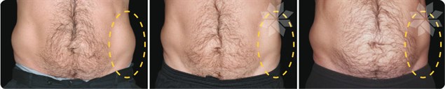 Another before and after CoolSculpting result in men. Results are evident by 60 days, with final results by 4 months.