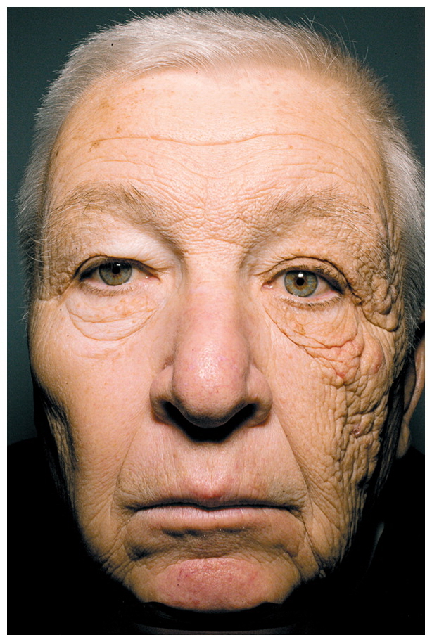 Unilateral dermatoheliosis -