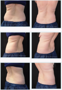 CoolSculpting PERMANENTLY reduces fat up to 25% in a single hour, performed in Dr. Horton's office without surgery or downtime