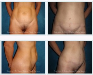 Before and after abdominoplasty - obvious rectus diastasis is corrected from top to bottom, with a low, short scar. While some might call this a "mini" abdominoplasty, the full job was completed!