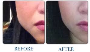 masseter1