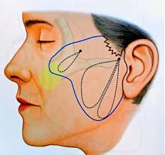 The MACS lift (minimal access cranial suspension) focuses on the neck and jowls and is a perfect short-scar, permanent solution to treat the male neck!