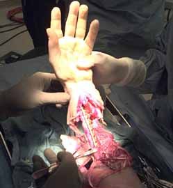 Mangling injuries to the hand are devastating for anyone who uses their hands for a living. Reconstructive Microsurgery can help restore form and function to the body.