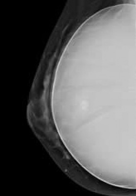 A breast implant is clearly visible on a mammogram and does not create the changes in the breast seen with fat grafting.