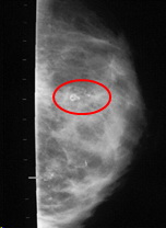 calcifications on mammogram after fat grafting