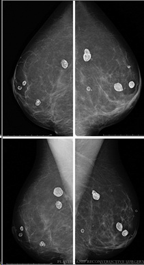 oil cysts on mammogram after fat grafting