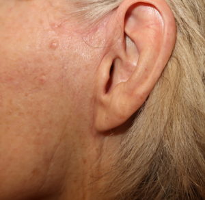 MACS lift scar