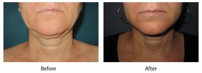 before and after facelift results