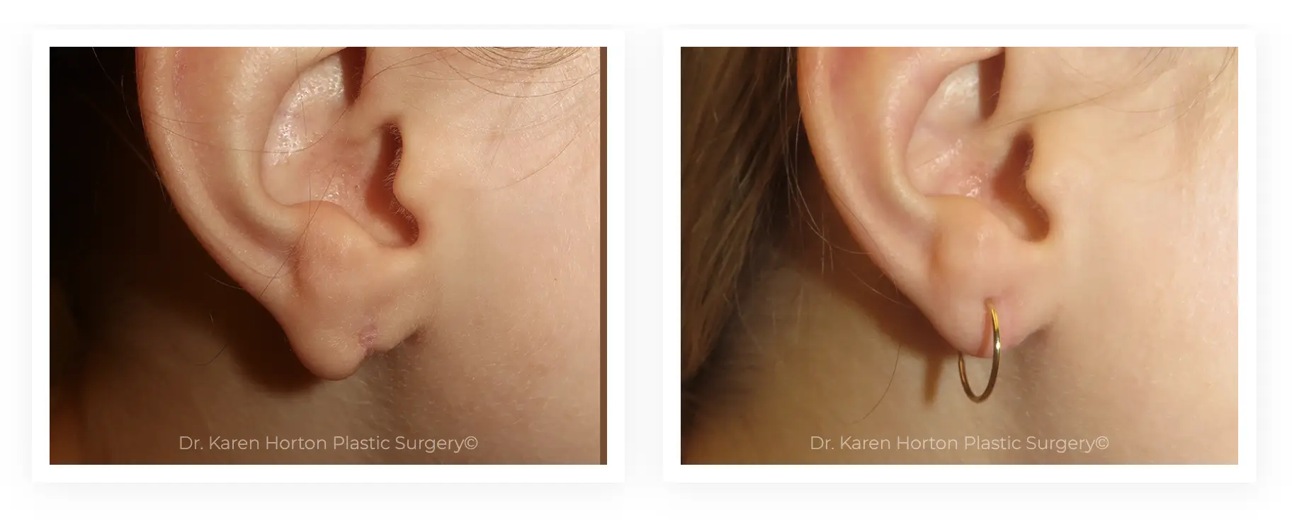 ear lobe repair results before after