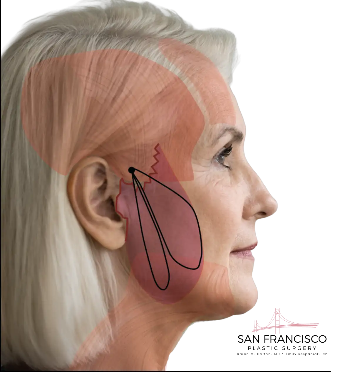 MACS facelift diagram