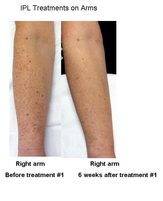 Arms before and after IPL 2