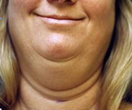 Double-Chin