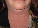 LipoBefore