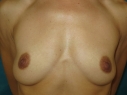breast augmentation dr karen horton before