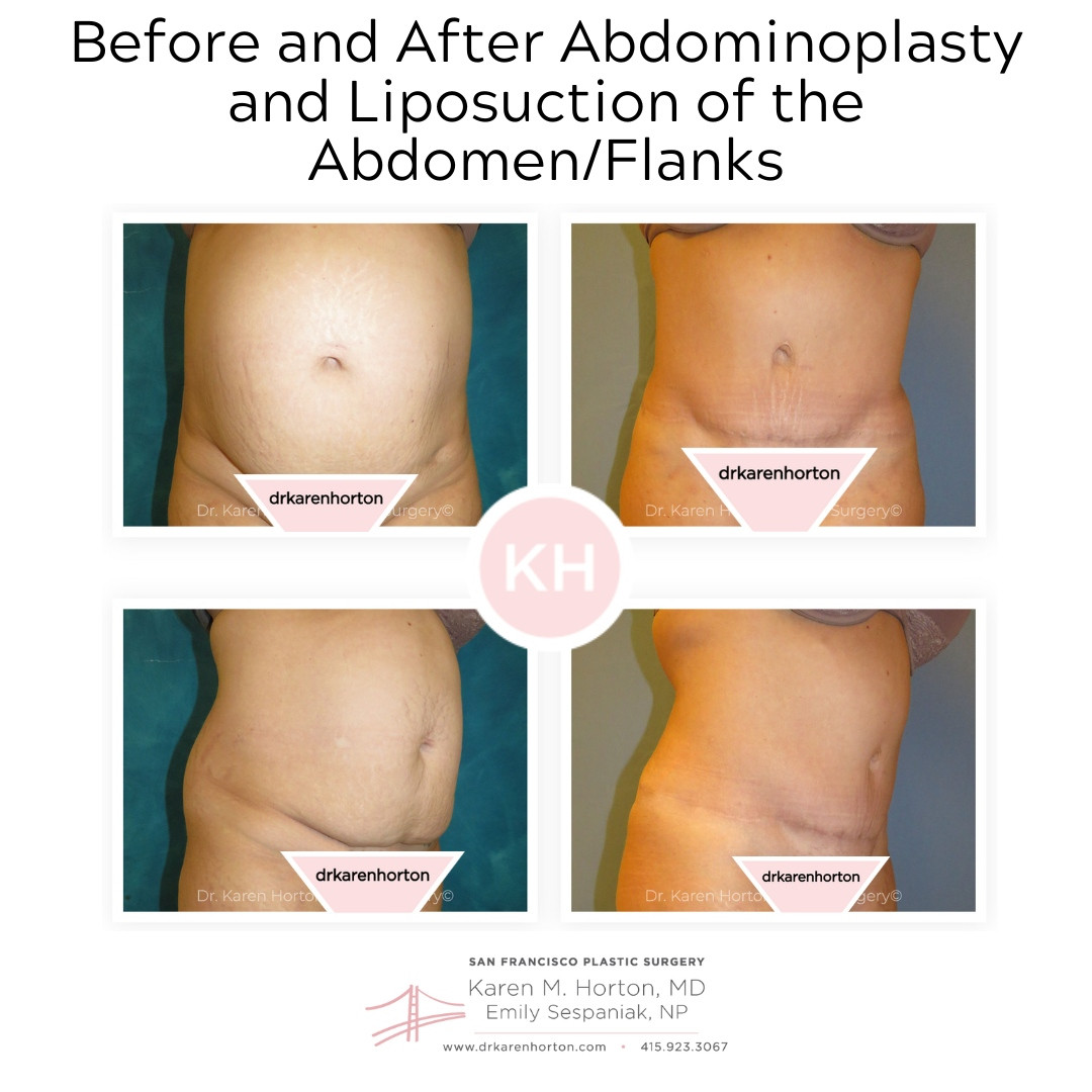 dr karen horton Before and after abdominoplasty and liposuction