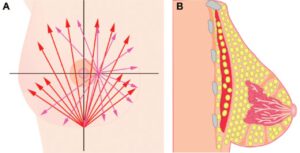 fat grafting to breast image