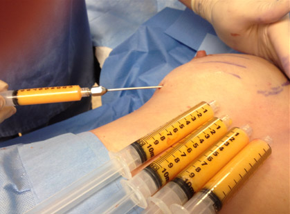 fat grafting to breasts