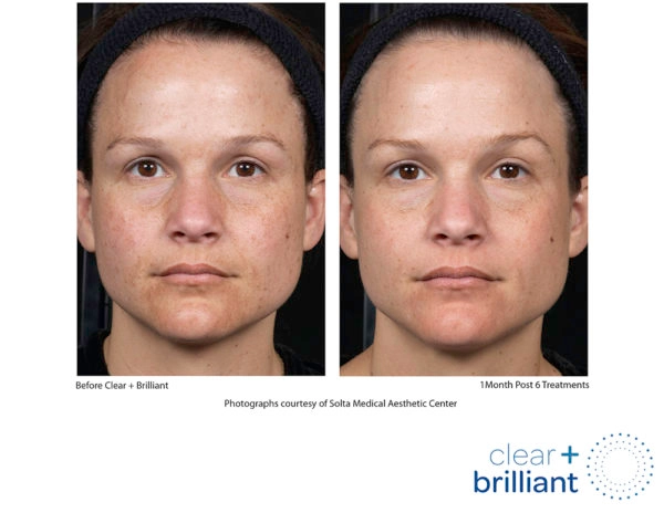 Clear + Brilliant before and after results