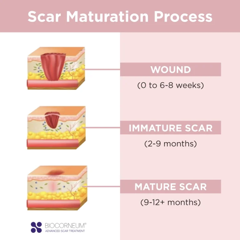 Biocorneum scar maturation process