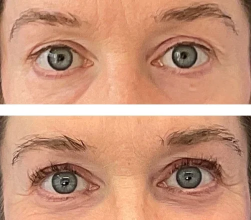 before and after latisse