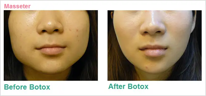 before and after masseter botox