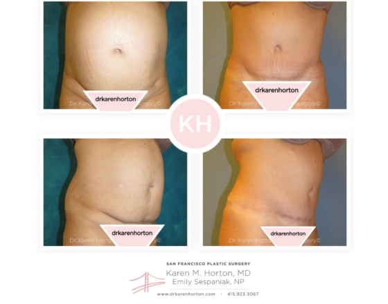 dr karen horton Before and after abdominoplasty and liposuction