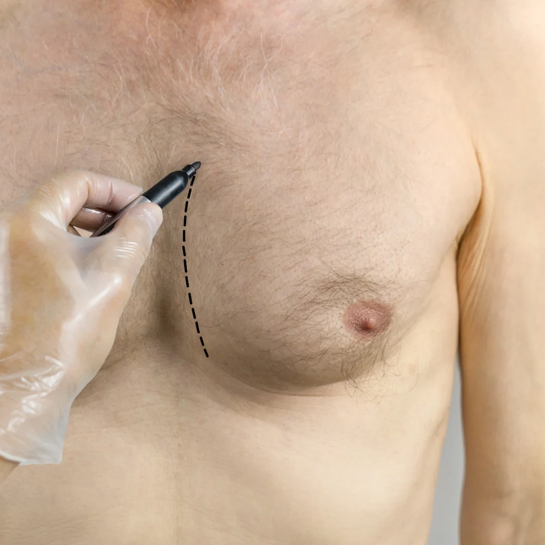 gynecomastia breast reduction surgery preparation