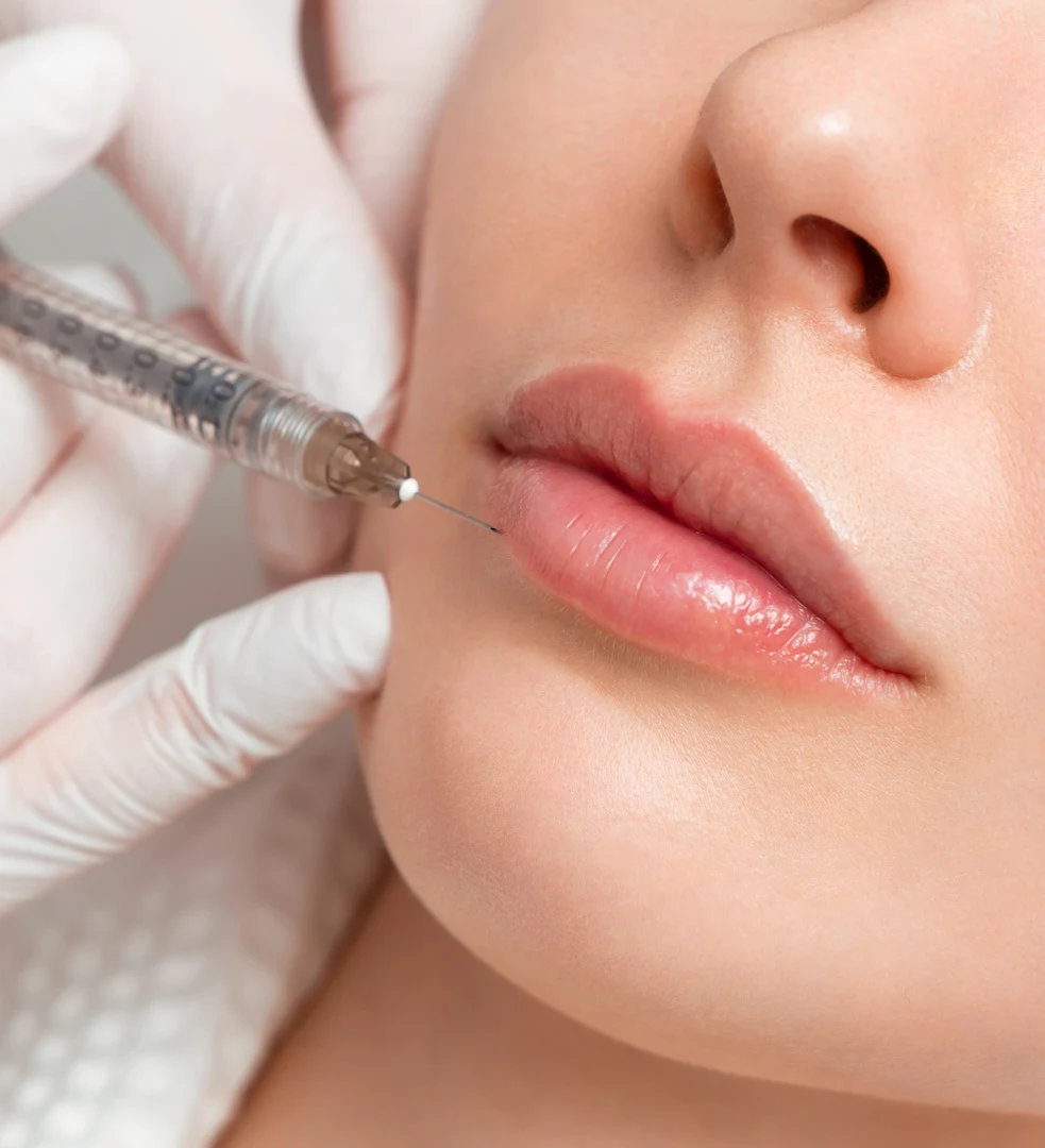lip filler procedure for fuller hydrated lips