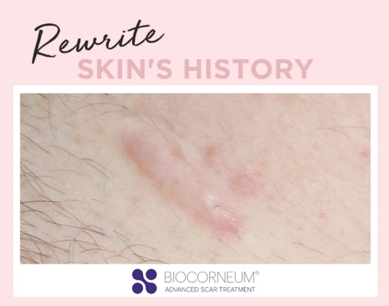 Improve Surgical Scars With Scar Therapy In San Francisco