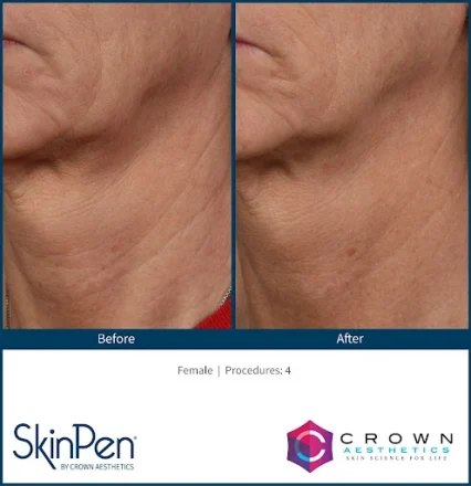 skinpen microneedling before and after