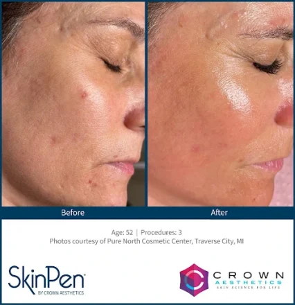 skinpen microneedling before and after