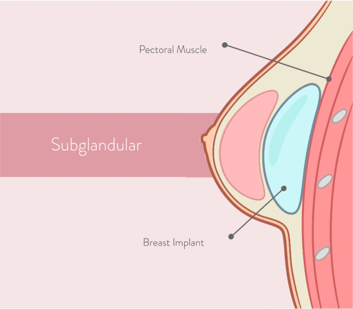 Subglandular breast implant placement diagram
