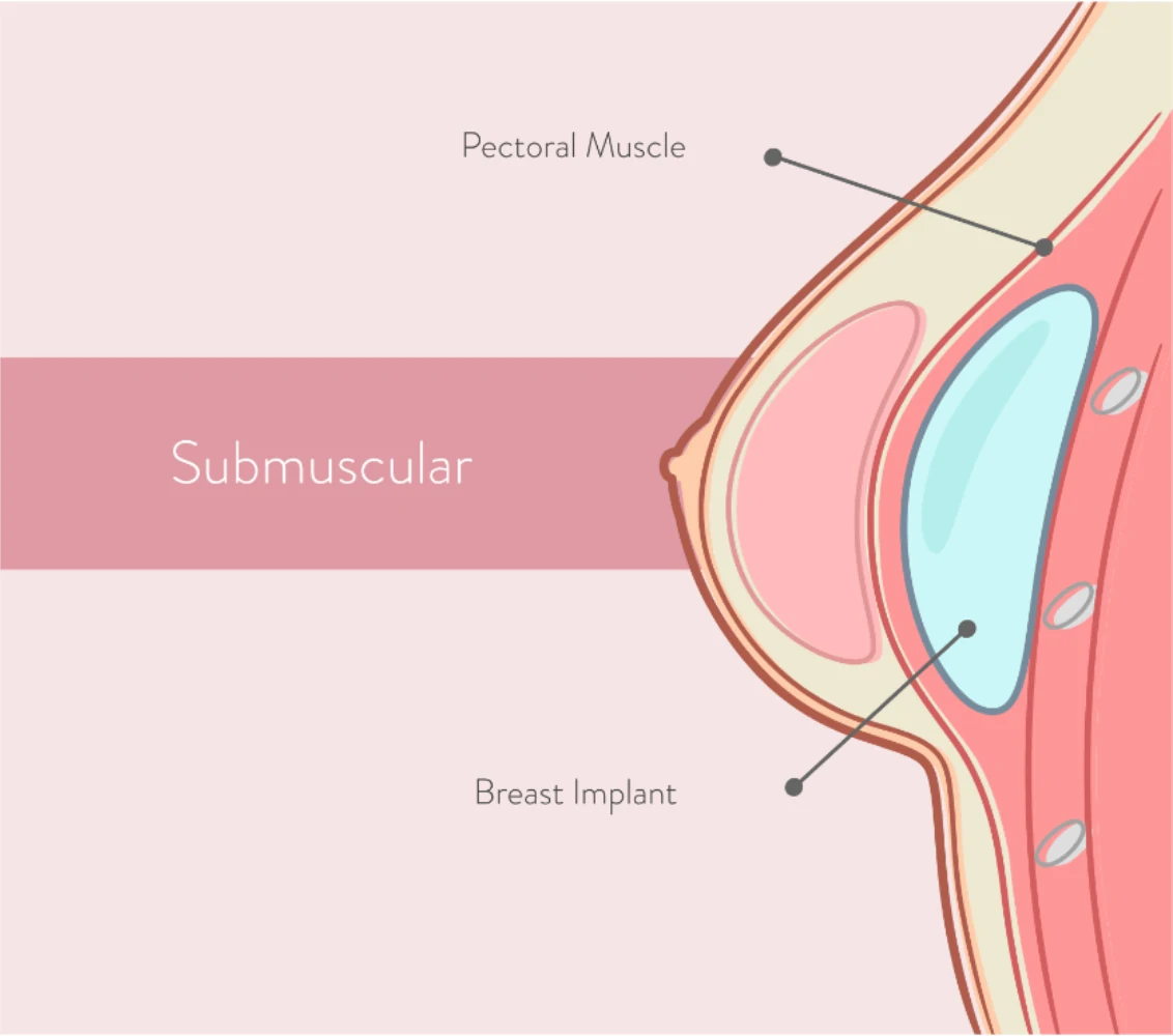 Submuscular breast implant placement diagram
