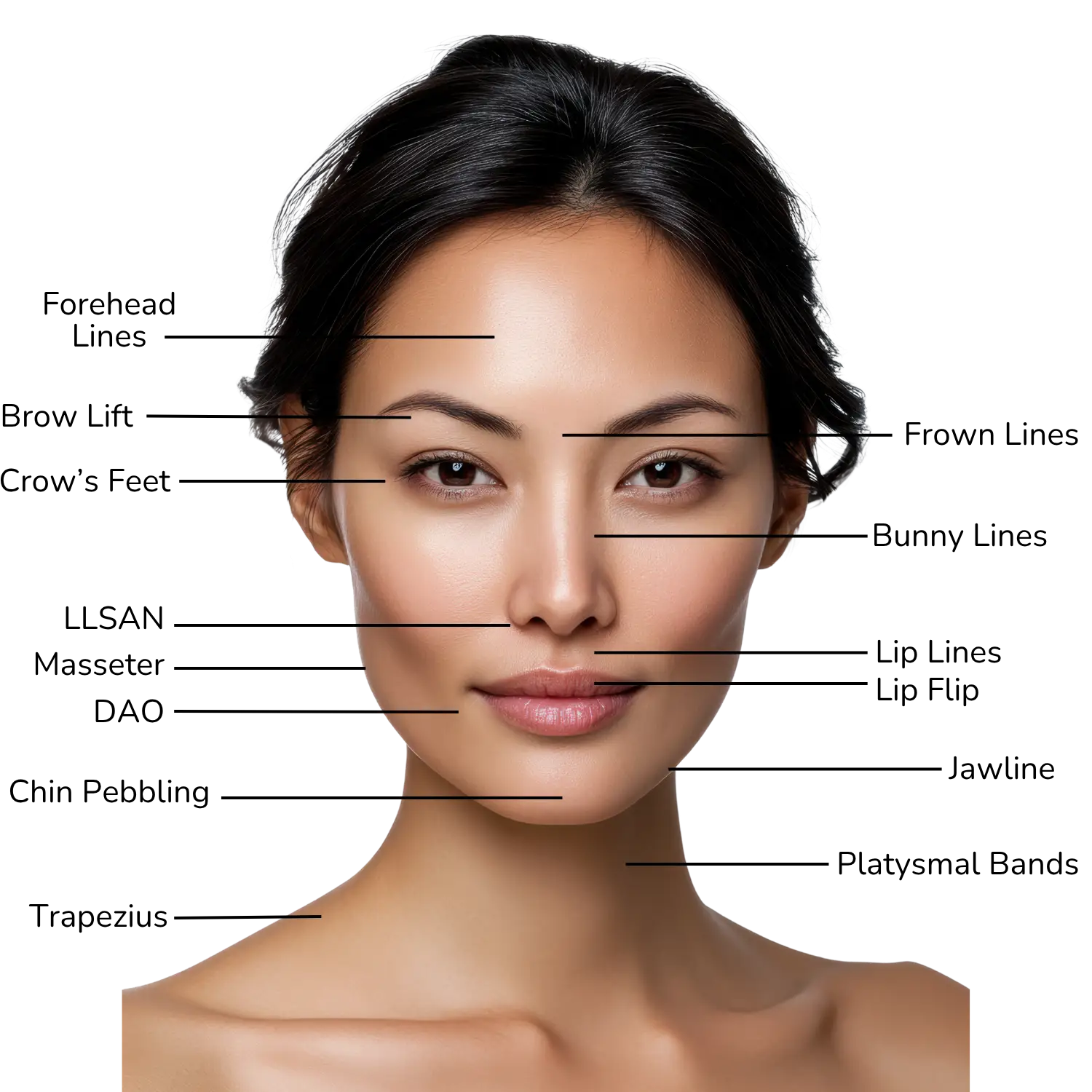 diagram showing botox treatment areas on face
