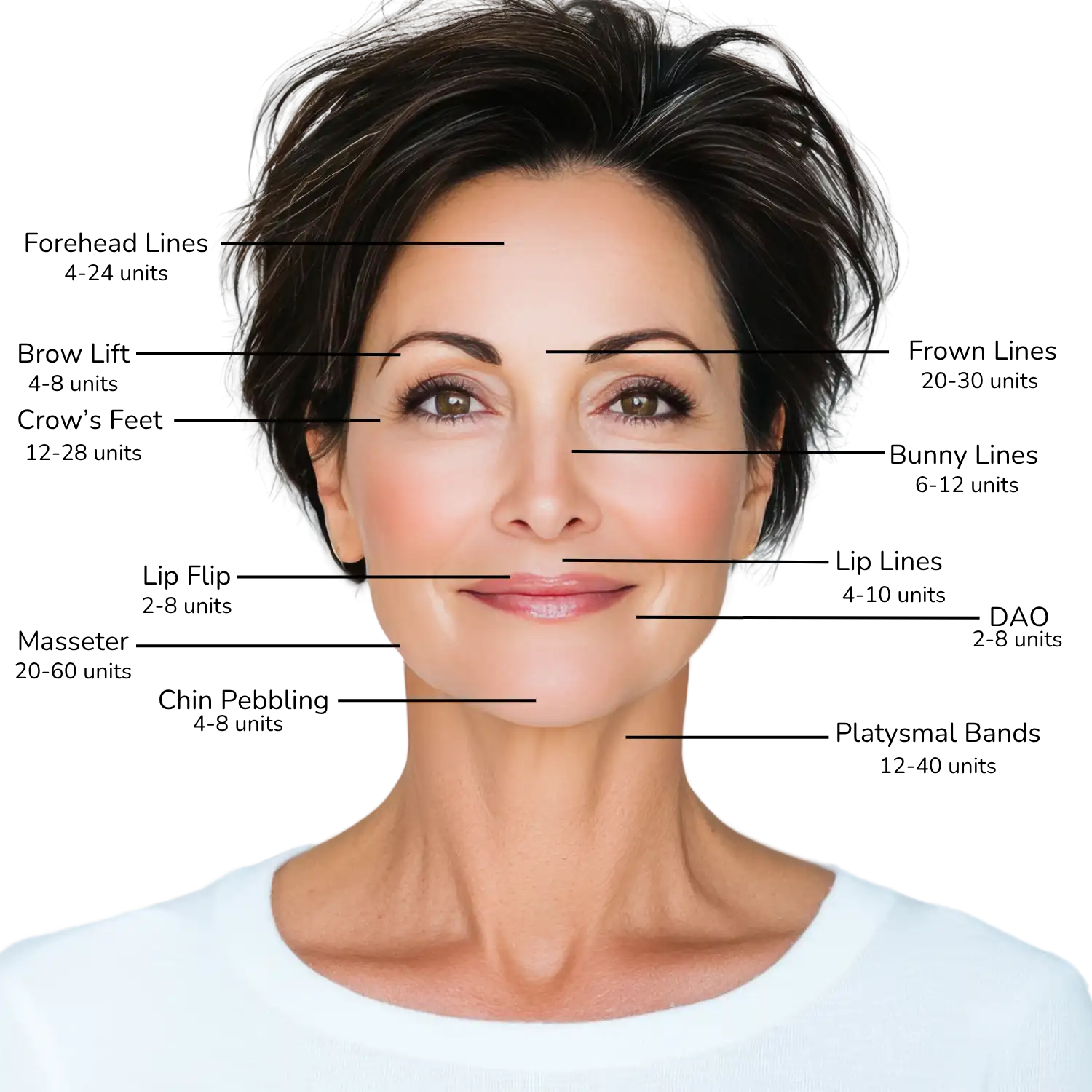 botox unit amounts diagram