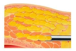 fat grafting to breast graphic