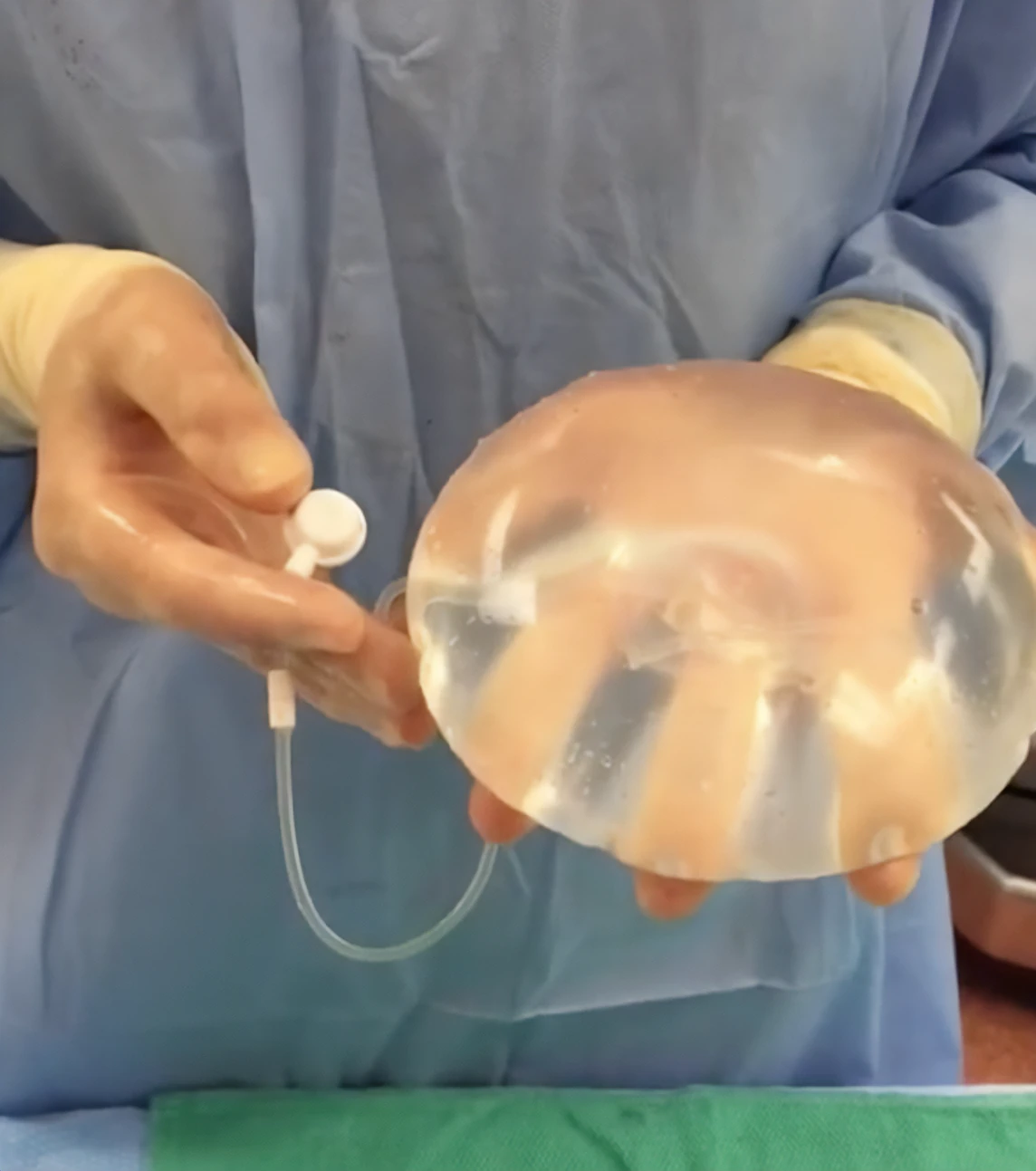 Dr. Horton demonstrates the difference between the adjustable saline implant and silicone implant