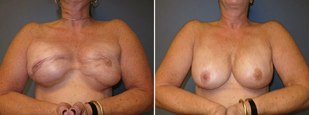 Intraoperative view of a breast revision surgery by Dr. Karen Horton 
