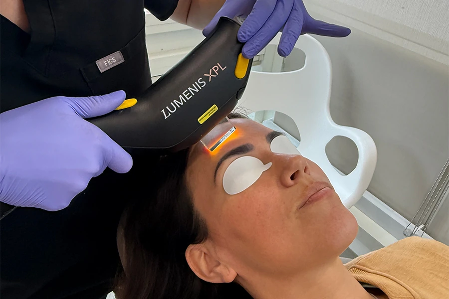 Stellar M22 IPL device by Lumenis treatment on patient at San Francisco Plastic Surgery