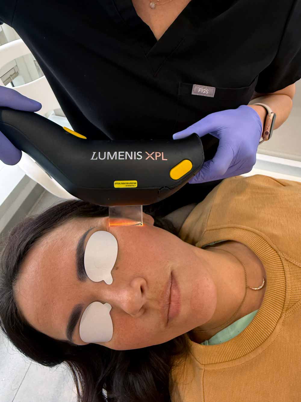 Female patient receiving IPL treatment on skin at Karen Horton's office with the Stellar M22 XPL system by Lumenis